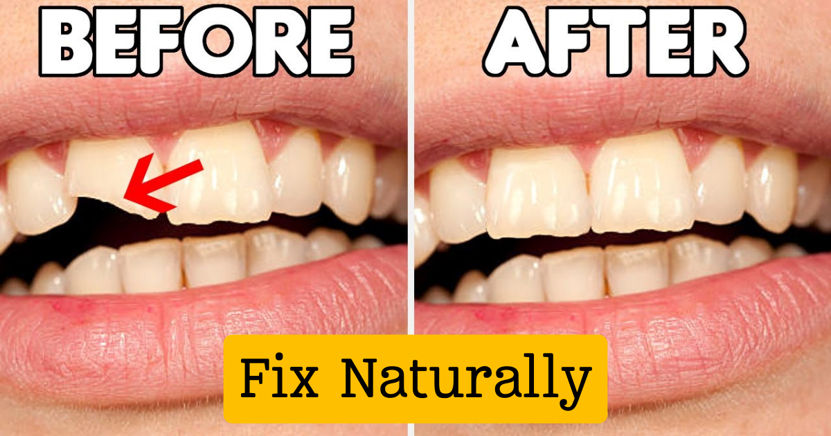 How to Fix a Cracked Tooth Naturally